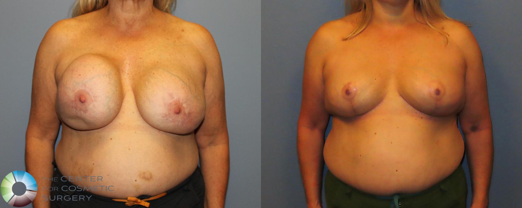 Before & After Breast Implant Removal (Explant) Case 12157 Front in Denver and Colorado Springs, CO