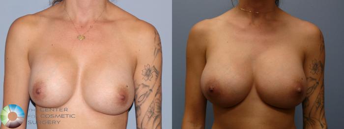 Before & After Breast Implant Revision Case 11765 Front in Denver, CO