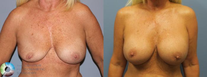 Before & After Breast Implant Revision Case 11799 Front in Denver, CO