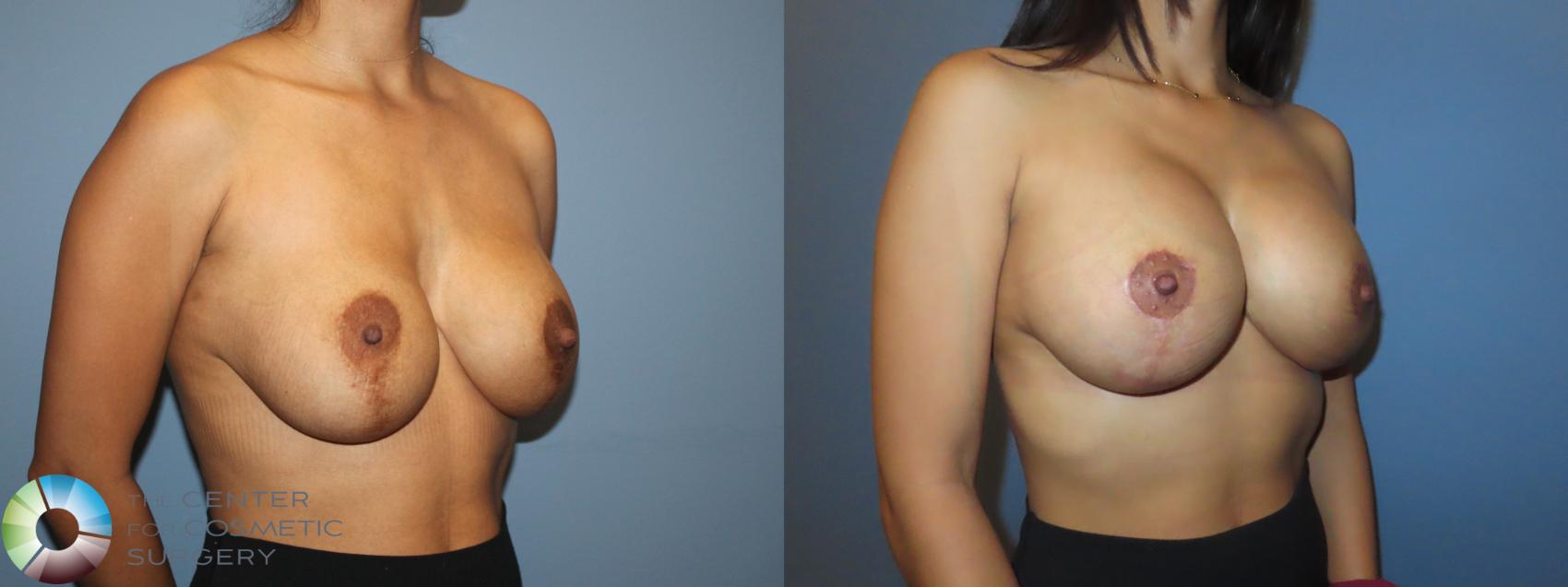 Best Denver Breast Implant Revision/Lift