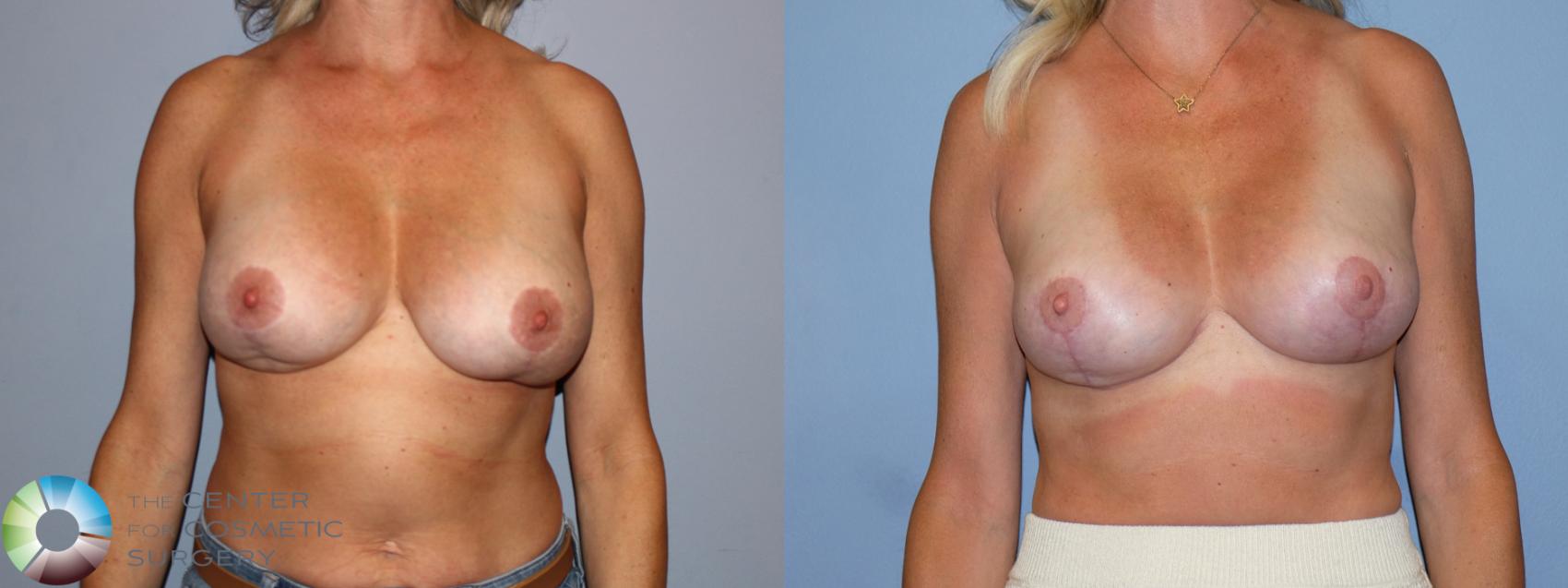 Before & After Breast Implant Revision Case 12171 Front in Denver and Colorado Springs, CO