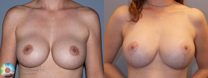 Before & After Breast Implant Revision Case 784 Anterior in Denver, CO