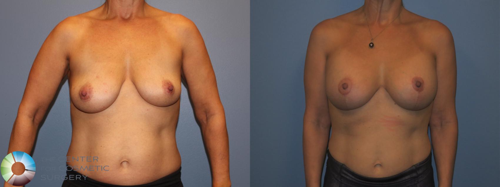 Before & After Breast Lift Case 11308 Front in Denver, CO