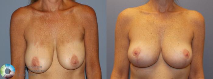 Before & After Breast Lift Case 11508 Front in Denver, CO