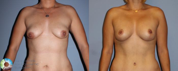 Before & After Breast Lift Case 11513 Front in Denver, CO