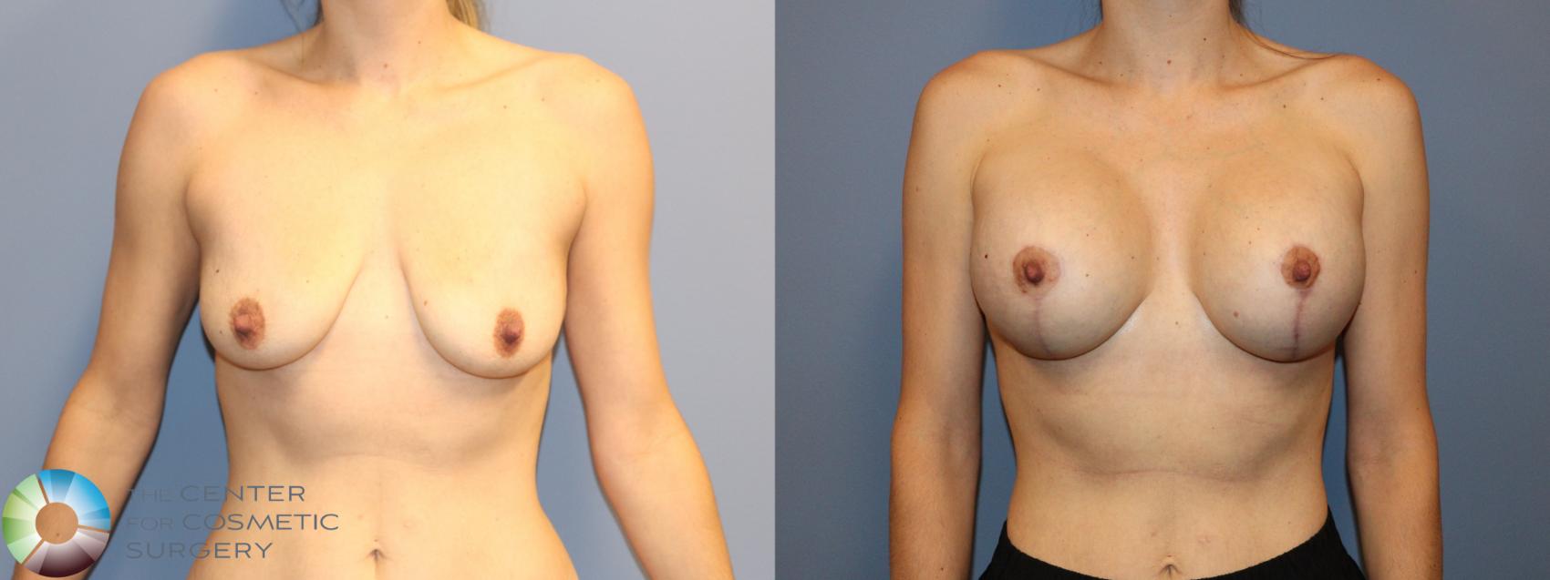 Before & After Breast Augmentation Case 12166 Front in Denver and Colorado Springs, CO