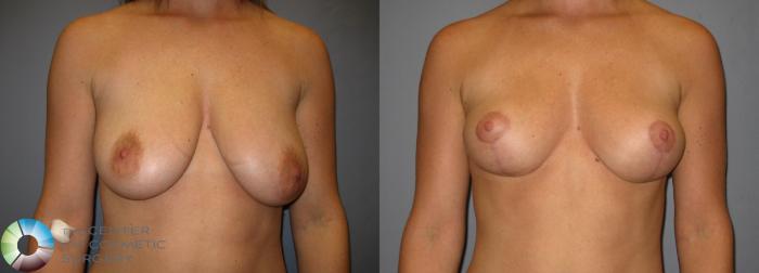 Before & After Breast Lift without Implants Case 238 View #1 in Denver, CO