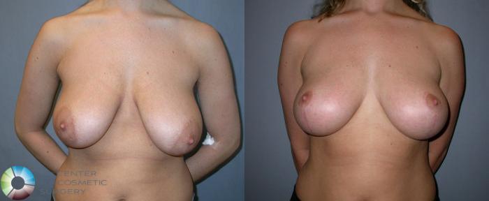 Before & After Breast Lift Case 37 View #1 in Denver, CO