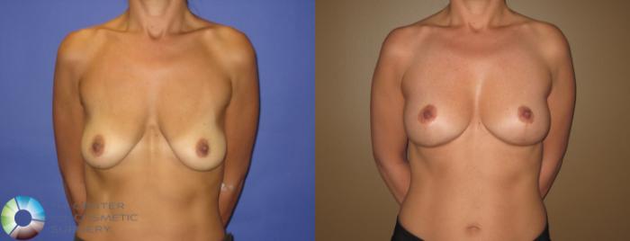 Before & After Breast Lift without Implants Case 390 View #1 in Denver, CO