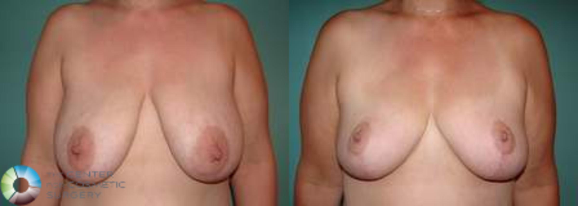 Breast Lift Case 543 Before & After View #1 | Golden, CO | The Center for Cosmetic Surgery