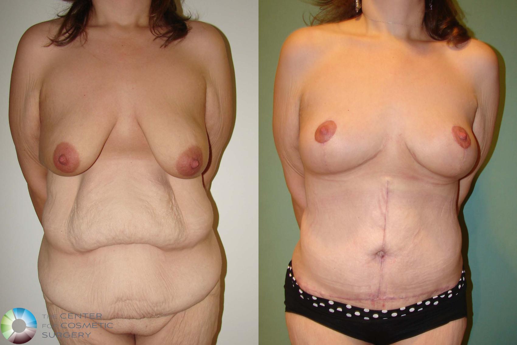 Before & After Breast Lift Case 664 View #1 in Denver, CO
