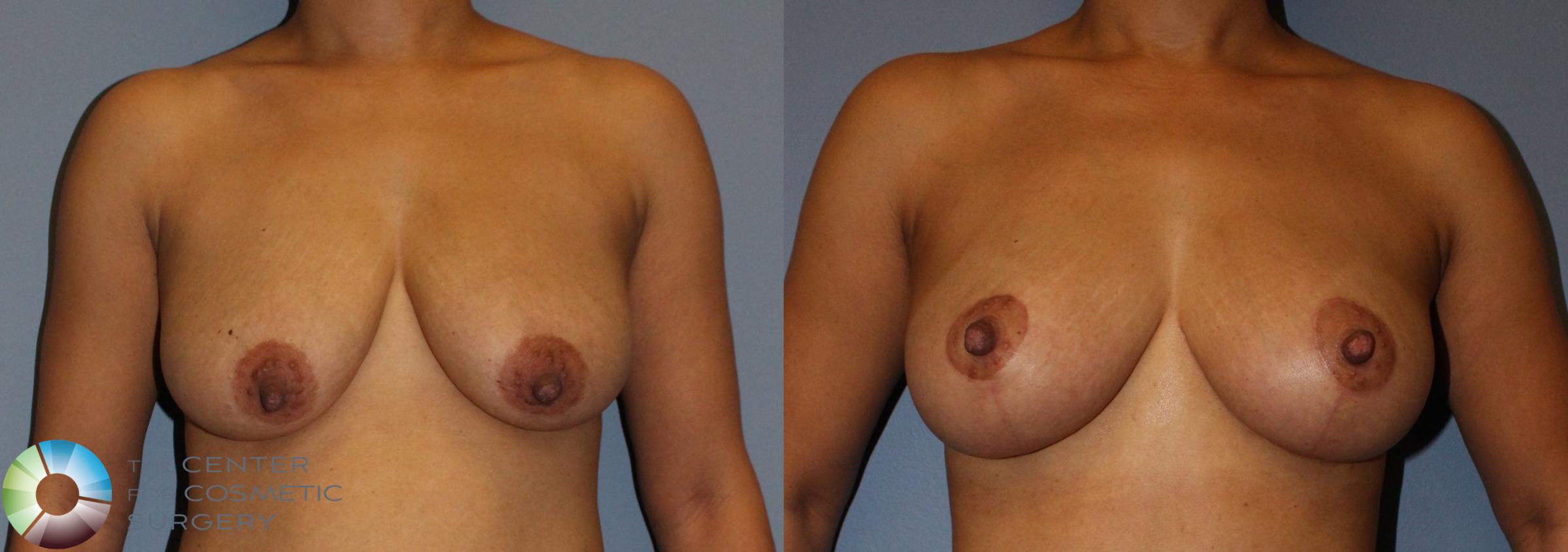 Breast Lift Case 808 Before & After View #1 | Golden, CO | The Center for Cosmetic Surgery