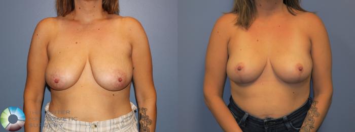 Before & After Breast Lift without Implants Case 11518 Front in Denver, CO