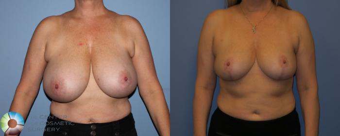 Before & After Breast Reduction Case 11288 Front in Denver, CO