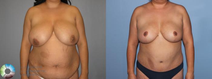 Before & After Breast Reduction Case 11290 Front in Denver, CO