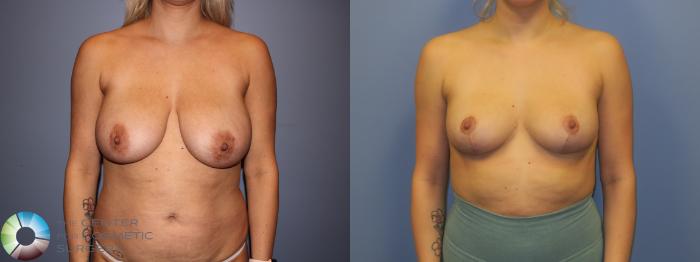 Before & After Breast Reduction Case 11291 Front in Denver, CO
