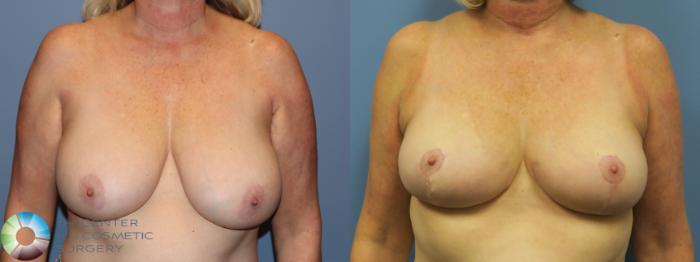 Before & After Breast Reduction Case 11697 Front in Denver, CO
