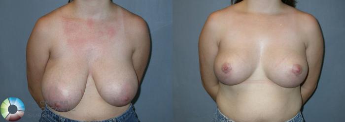 Before & After Breast Reduction Case 27 View #1 in Denver, CO