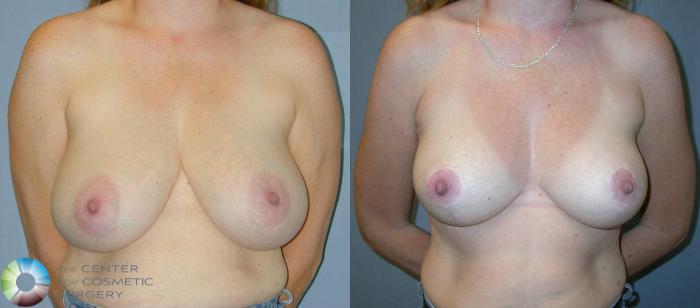 Before & After Breast Reduction Case 28 View #1 in Denver, CO