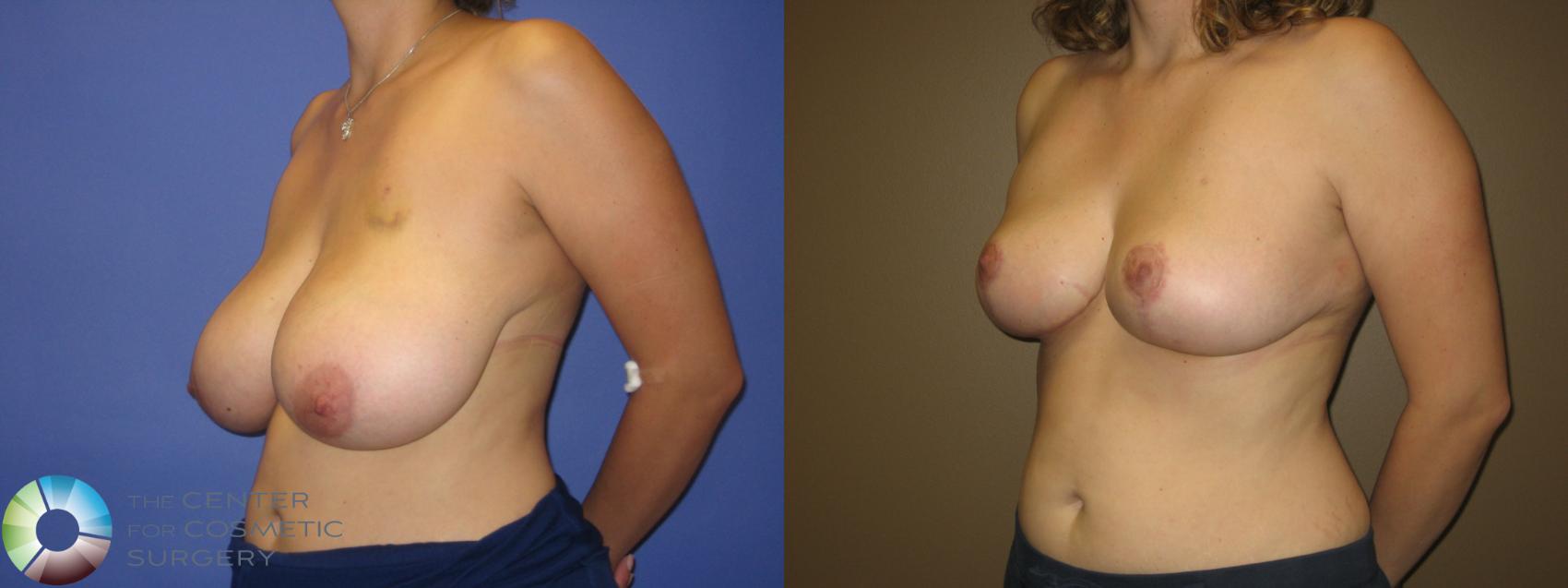 Breast Reduction Case 292 Before & After View #1 | Golden, CO | The Center for Cosmetic Surgery