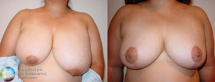 Before & After Breast Reduction Case 524 View #1 in Denver, CO