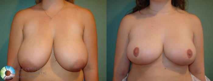 Before & After Breast Reduction Case 616 View #1 in Denver, CO