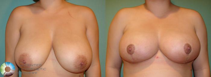 Before & After Breast Reduction Case 894 View #1 in Denver, CO