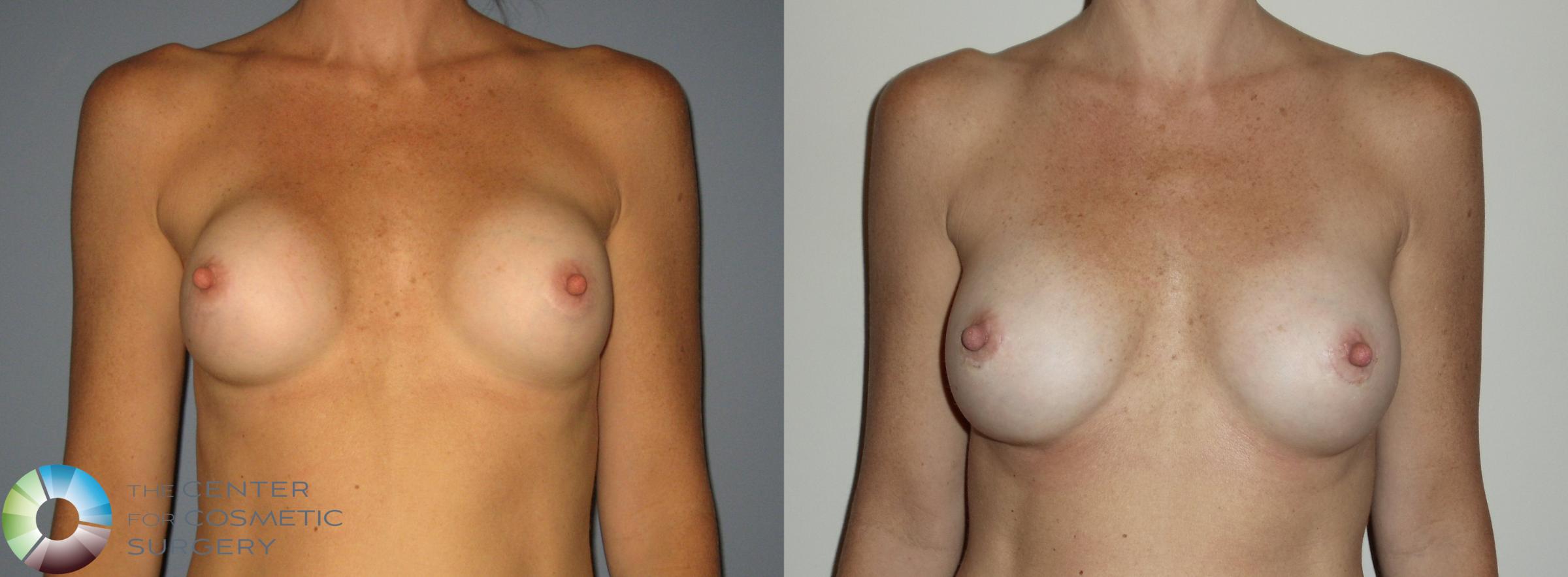 Breast Augmentation Case 395 Before & After View #1 | Golden, CO | The Center for Cosmetic Surgery