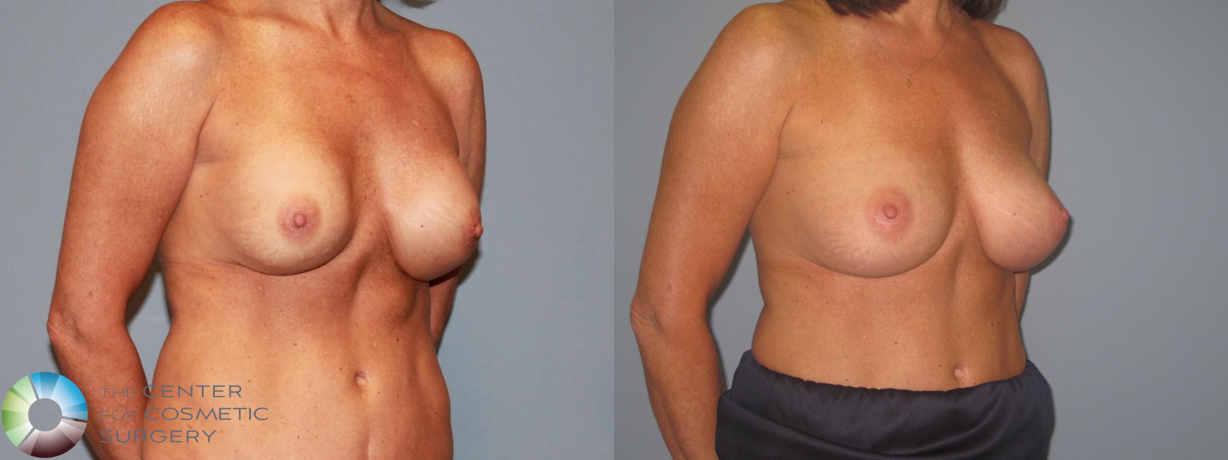 Before & After Breast Implant Revision Case 713 View #1 View in Denver & Golden, CO