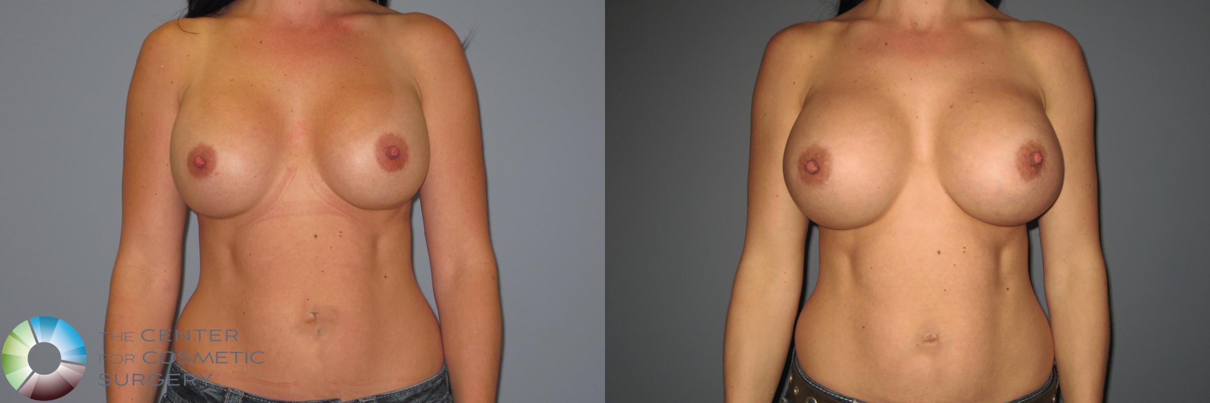 Breast Revision Case 874 Before & After View #1 | Golden, CO | The Center for Cosmetic Surgery