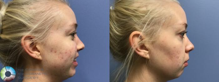 Before & After Chemical Peels/Microdermabrasion Case 11598 Right Side in Denver and Colorado Springs, CO