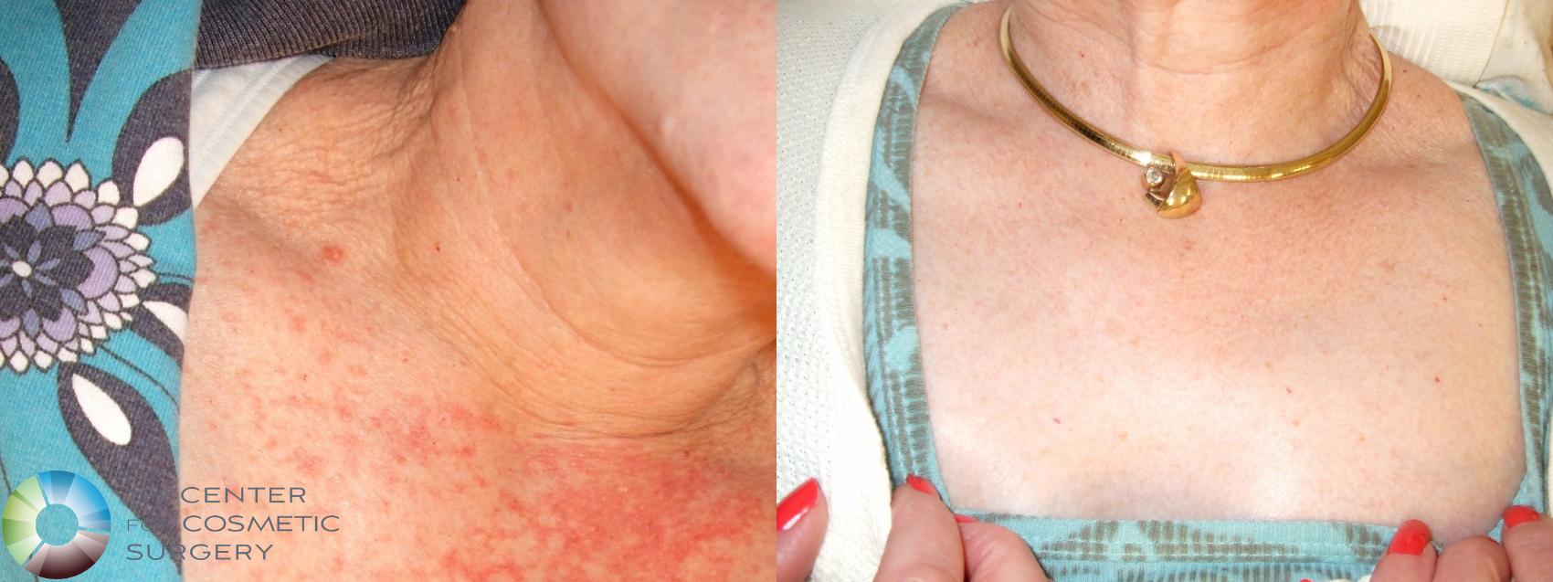 Before & After Chemical Peels/Microdermabrasion Case 264 View #1 in Denver, CO