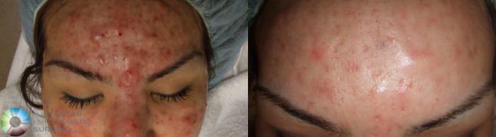 Before & After Chemical Peels/Microdermabrasion Case 277 View #1 in Denver and Colorado Springs, CO