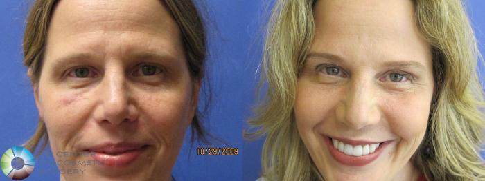 Before & After Laser Skin Resurfacing Case 383 View #1 in Denver and Colorado Springs, CO