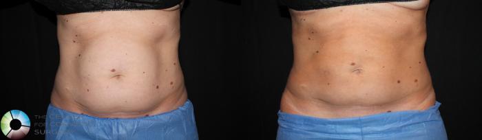 Before & After CoolSculpting Case 725 View #1 in Denver, CO