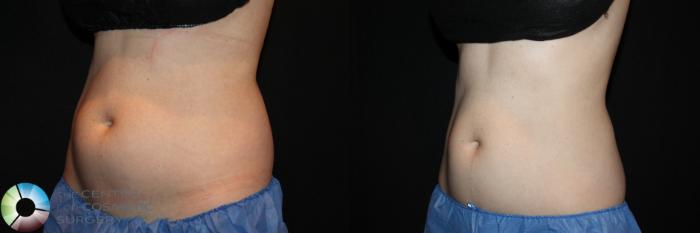 Before & After CoolSculpting Case 726 View #1 in Denver, CO