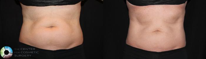 Before & After CoolSculpting Case 735 View #1 in Denver, CO