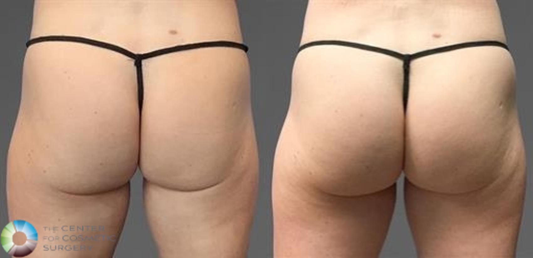 CoolTone Case 11566 Before & After Back | Golden, CO | The Center for Cosmetic Surgery