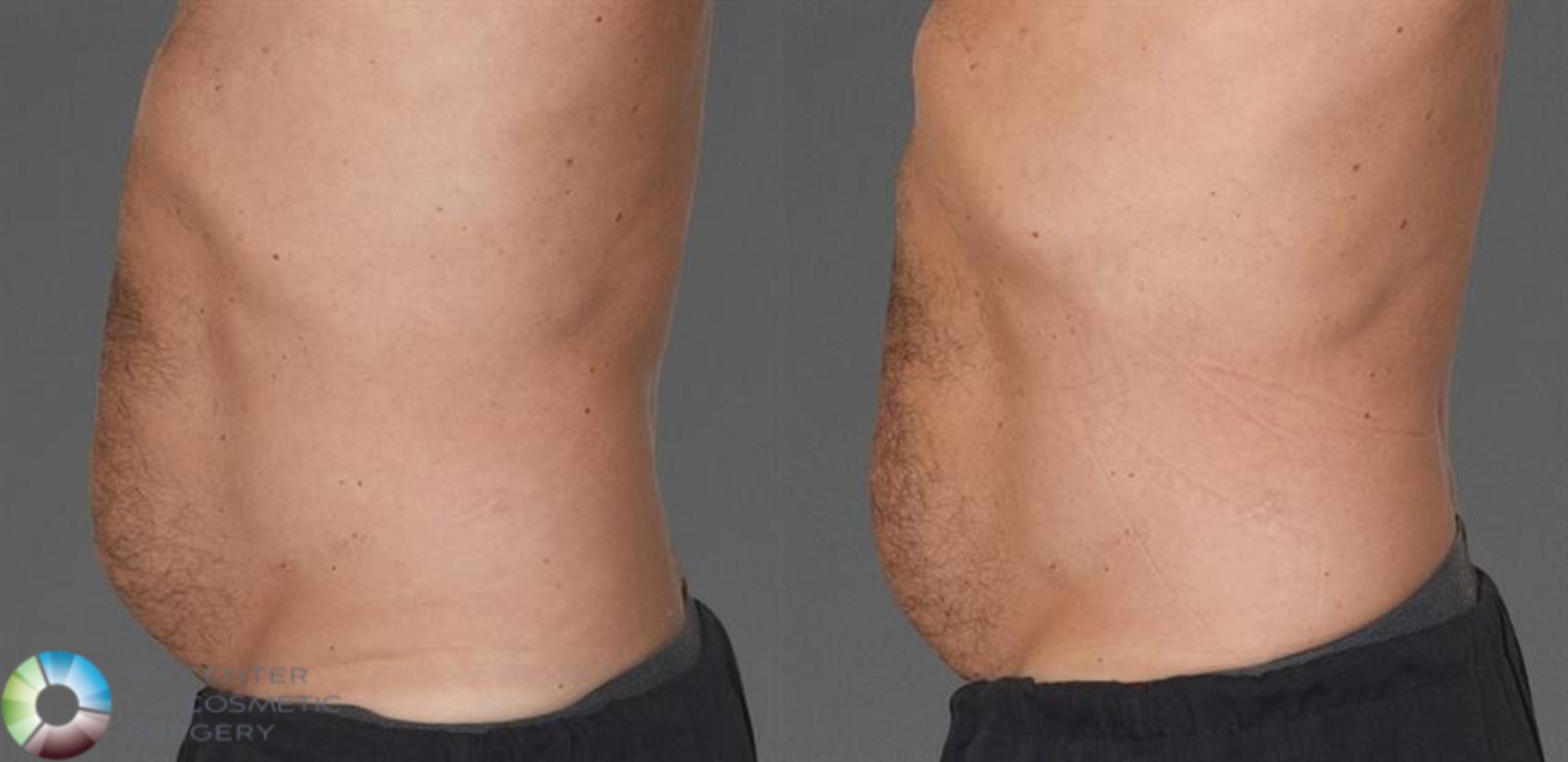 CoolTone Case 11567 Before & After Left Side | Golden, CO | The Center for Cosmetic Surgery