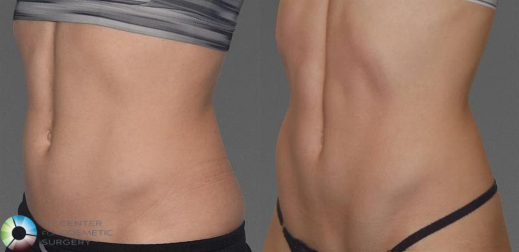 CoolTone Case 11568 Before & After Left Oblique | Golden, CO | The Center for Cosmetic Surgery