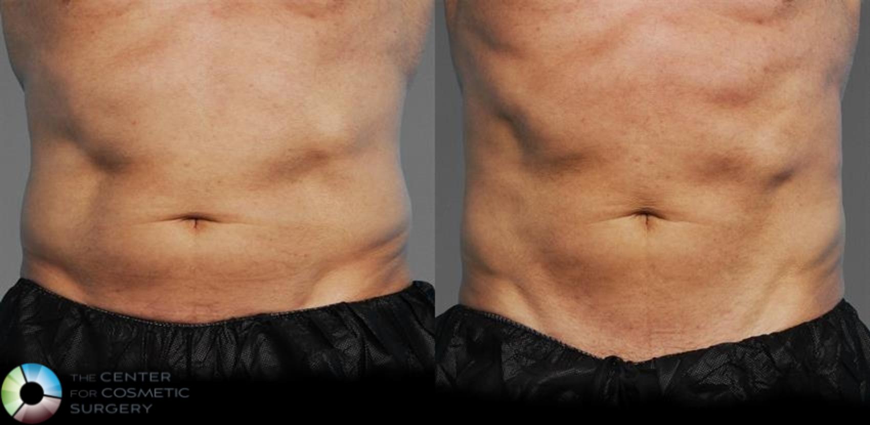 CoolTone Case 11569 Before & After Front | Golden, CO | The Center for Cosmetic Surgery