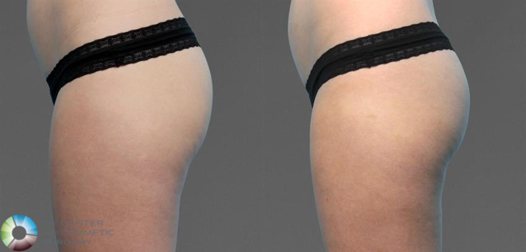 CoolTone Case 11570 Before & After Left Side | Golden, CO | The Center for Cosmetic Surgery