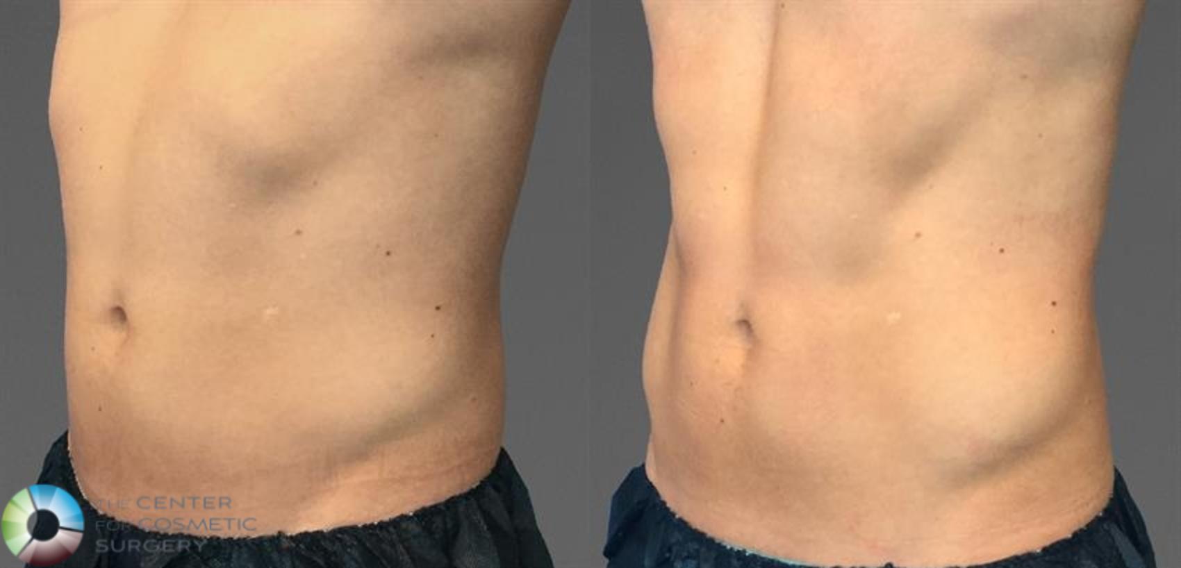CoolTone Case 11571 Before & After Left Oblique | Golden, CO | The Center for Cosmetic Surgery
