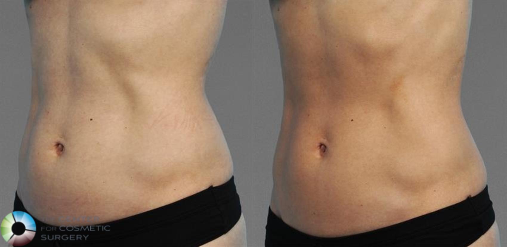 CoolTone Case 11572 Before & After Left Oblique | Golden, CO | The Center for Cosmetic Surgery