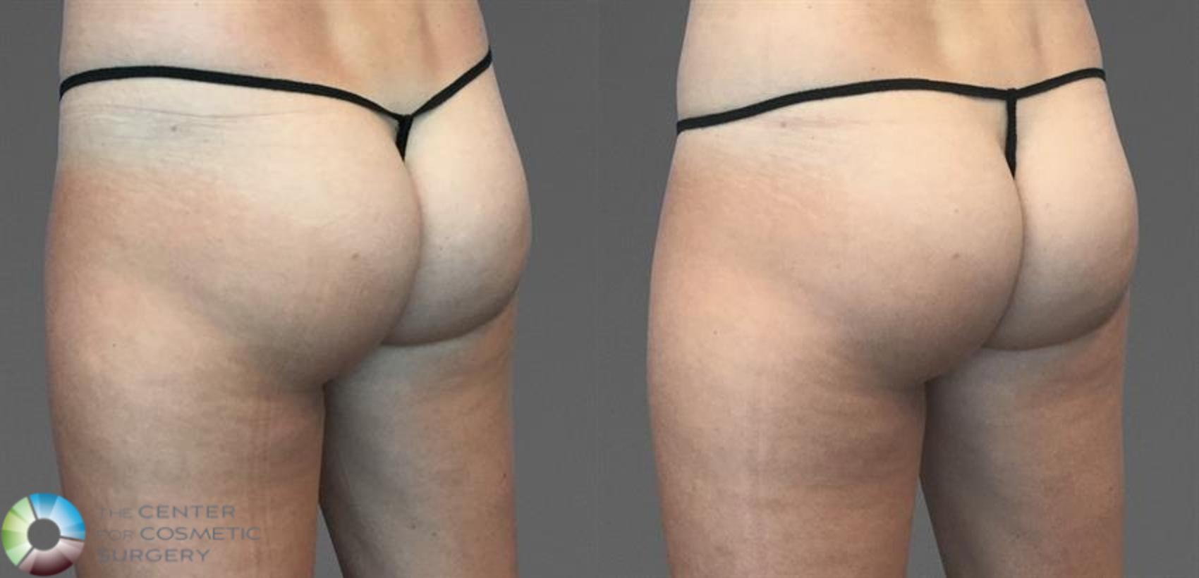 CoolTone Case 11573 Before & After Back | Golden, CO | The Center for Cosmetic Surgery