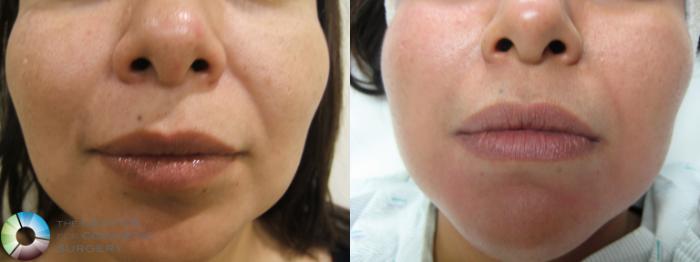 Before & After Dermal Fillers Case 282 View #1 in Denver and Colorado Springs, CO