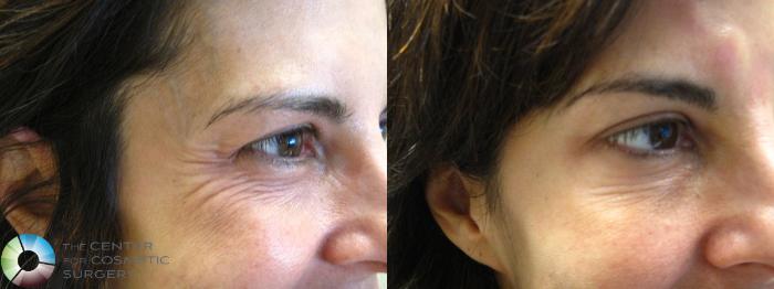 Before & After Dysport® Case 384 View #1 in Denver, CO