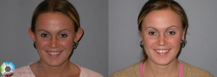 Before & After Ear Surgery Case 108 View #1 in Denver and Colorado Springs, CO