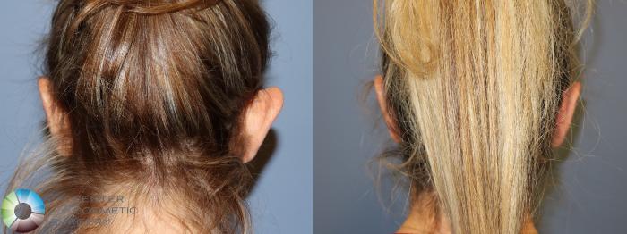 Before & After Ear Surgery Case 11695 Back in Denver and Colorado Springs, CO