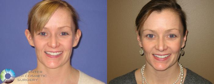 Before & After Ear Surgery Case 283 View #1 in Denver and Colorado Springs, CO